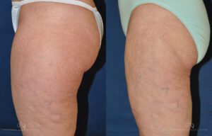 Patient 6 - Liposuction Side Before and After