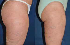 Patient 6 - Liposuction Side Before and After