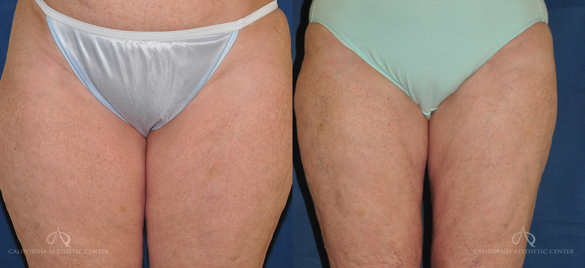 Patient 6 - Liposuction Front Before and After