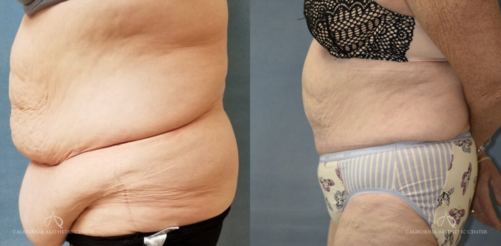 Patient 6 Panniculectomy Before and After Left Side View