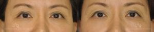 Patient 1 Asian Blepharoplasty Before and After Front View