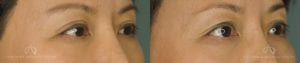 Patient 1 Asian Blepharoplasty Before and After Right Oblique View