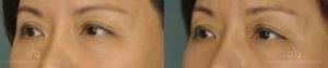 Patient 1 Asian Blepharoplasty Before and After Left Oblique View