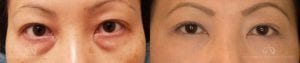 Patient 2 Asian Blepharoplasty Before and After Front View