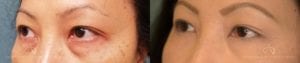 Patient 2 Asian Blepharoplasty Before and After Left Oblique View