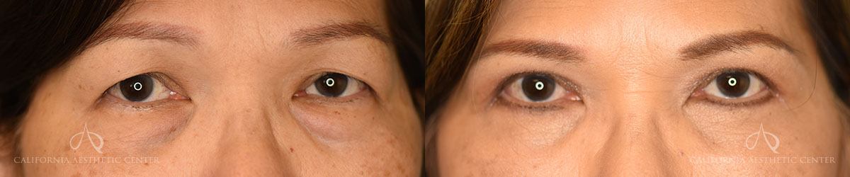 Patient 3 Asian Blepharoplasty Before and After Front View