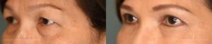 Patient 3 Asian Blepharoplasty Before and After Left Oblique View