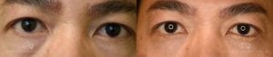 Patient 4 Asian Blepharoplasty Before and After Front View