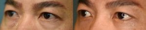 Patient 4 Asian Blepharoplasty Before and After Left Oblique View