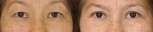 Patient 6 Asian Blepharoplasty Before and After Front View