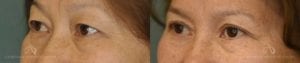 Patient 6 Asian Blepharoplasty Before and After Left Oblique View