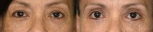 Patient 7 Asian Blepharoplasty Before and After Front View