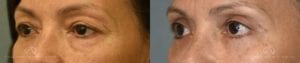 Patient 7 Asian Blepharoplasty Before and After Left Oblique View