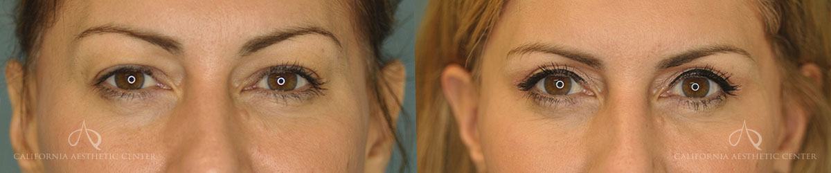 Patient 1 Blepharoplasty Before and After Front View