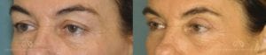Patient 3 Blepharoplasty Before and After Left Oblique View