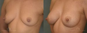 Patient 7 Breast Augmentation Before and After Left Oblique View