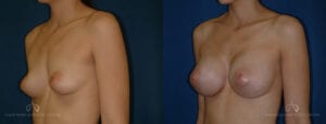 SteveVu_BreastAugmentation_Beforeandafter_Left-Oblique_Patient11