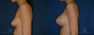 SteveVu_BreastAugmentation_Beforeandafter_Left-Side_Patient11
