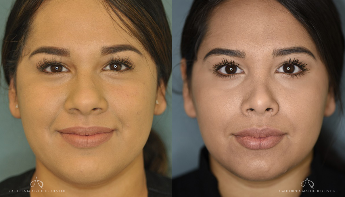 Patient 1 Rhinoplasty Before and After Front View