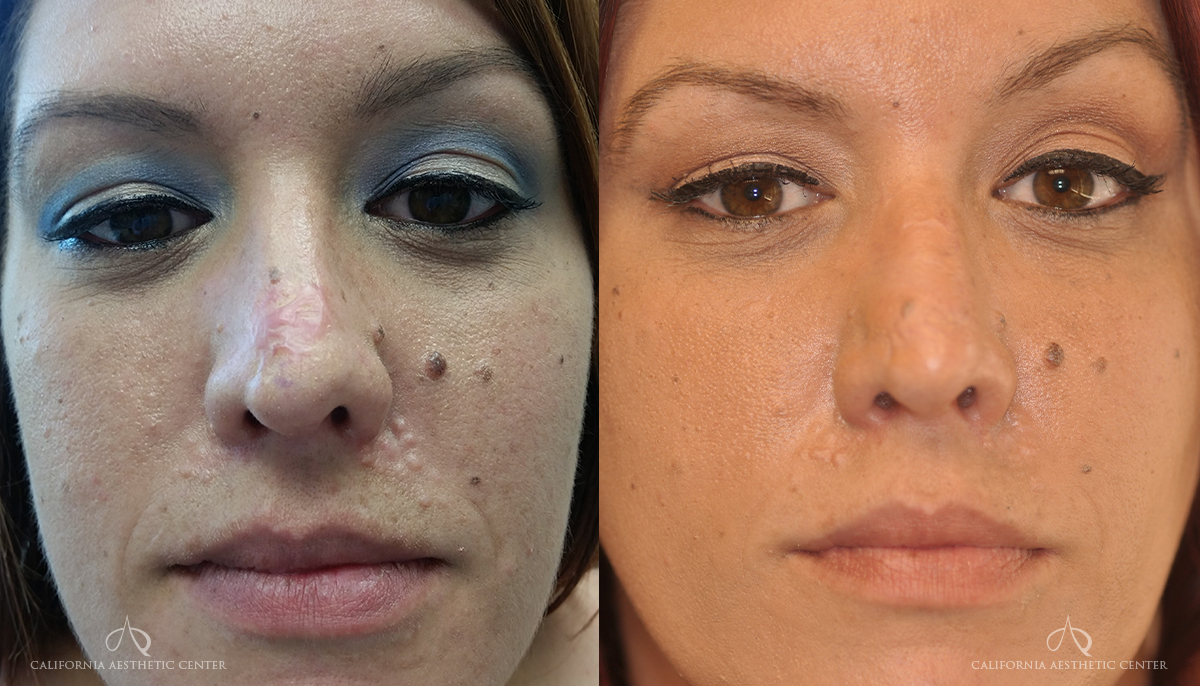 Patient 3 Rhinoplasty Before and After Front
