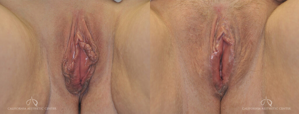Patient 1b Labiaplasty Before and After