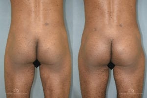 Patient 1 Brazilian Butt Lift Before and After Back View