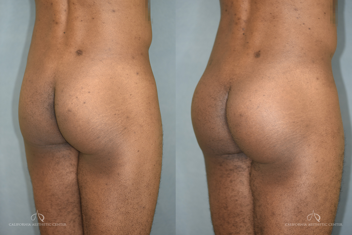 Brazilian Butt Lift vs. Traditional Butt Lift: What's the Difference? - Dr  Marco