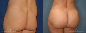 Patient 1 Brazilian Butt Lift Before and After Back Left Oblique View