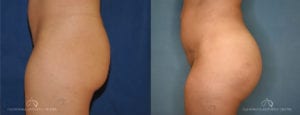 Patient 1 Brazilian Butt Lift Before and After Left Side View