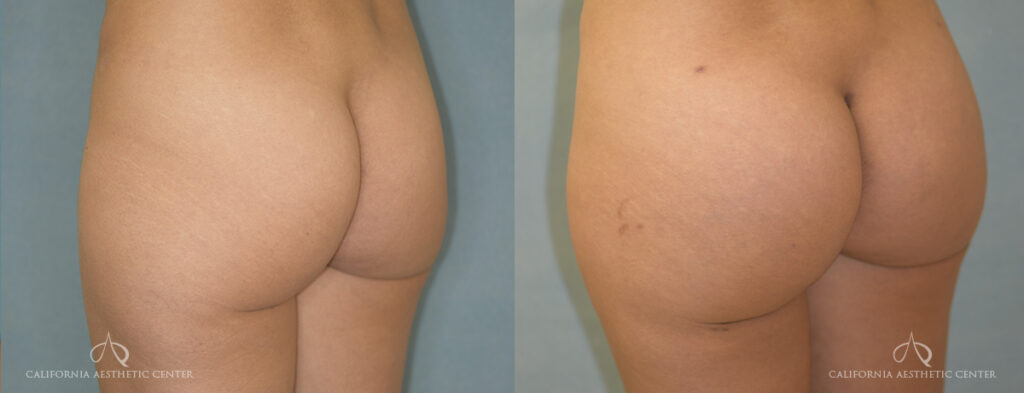 Patient 3 Brazilian Butt Lift Oblique Left Before and After