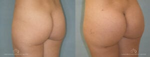 Patient 3 Brazilian Butt Lift Oblique Left Before and After
