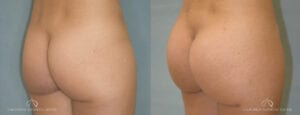 Patient 3 Brazilian Butt Lift Before and After Oblique Right