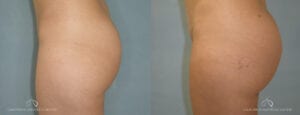 Patient 3 Brazilian Butt Lift Before and After Side