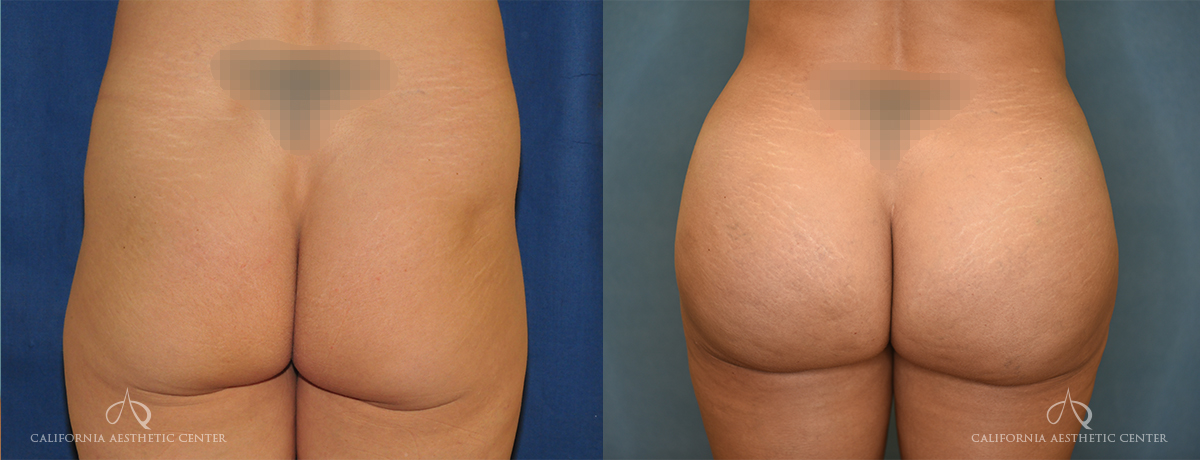 Patient 6 Brazilian Butt Lift Back Before and After
