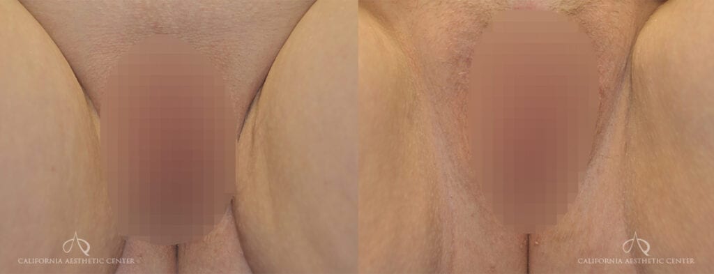 SteveVu Beforeandafter Labiaplasty Patient1 1 CENSORED