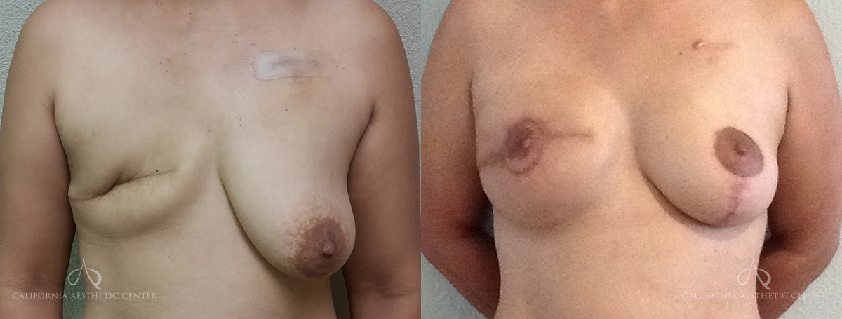 Patient 3 Breast Reconstruction Before and After Front