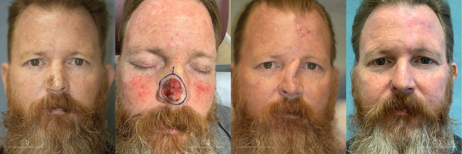 Patient 1 Skin Flap Before and After Front Big Photo