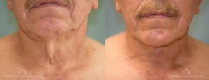 Patient 2 Neck Lift Front Before and After
