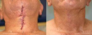 Patient 2 Neck Lift Under Before and After