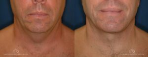 Patient 3 - Neck Lift Front Side Before and After