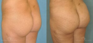 Patient 6 Brazilian Butt Lift Angle Before and After