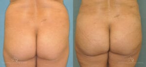 Patient 6 Brazilian Butt Lift Front Before and After