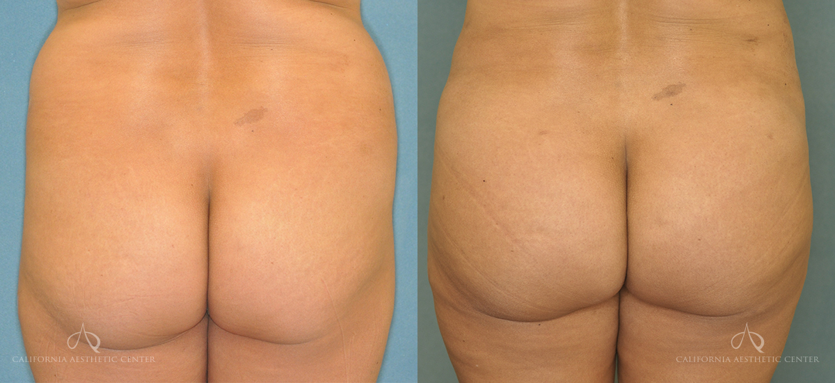 Patient 6 Brazilian Butt Lift Front Before and After
