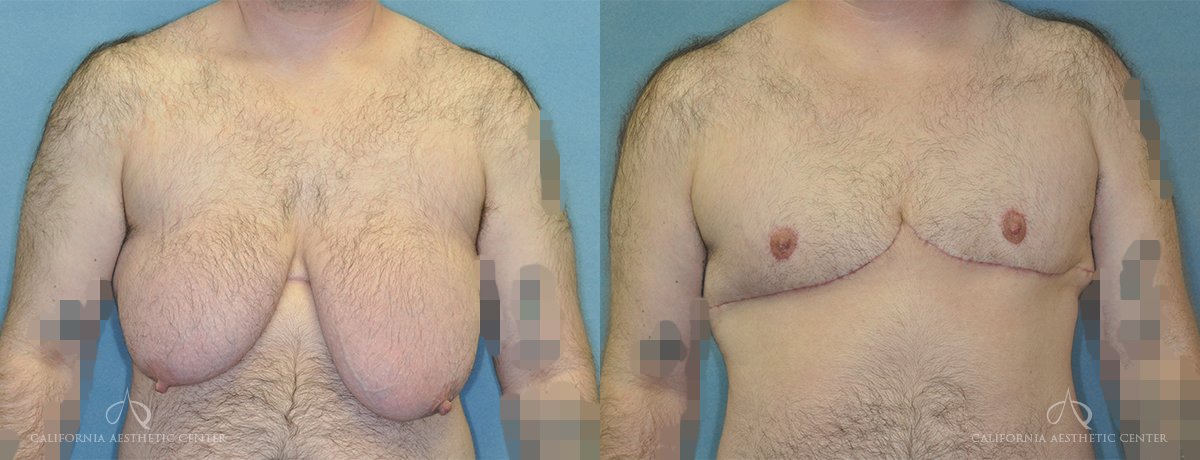 Patient 5 Gynecomastia Front Before and After