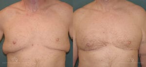 Patient 4 Liposuction Front Before and After