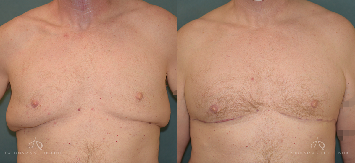 Patient 4 Liposuction Front Before and After