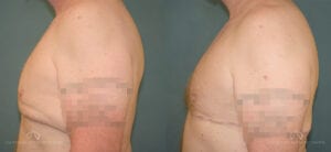 Patient 4 Liposuction Left Before and After