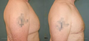 Patient 4 Liposuction Right Before and After