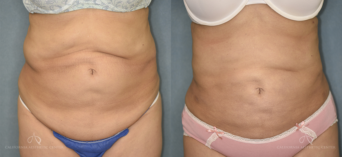 Patient 5 Liposuction Front Before and After