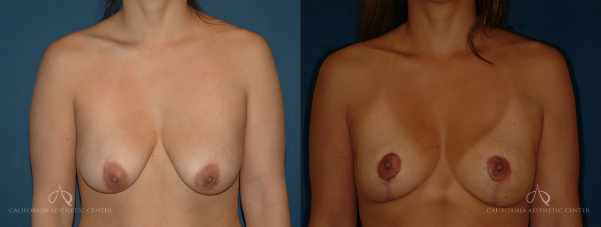 Patient 6 - Breast Lift Before and After